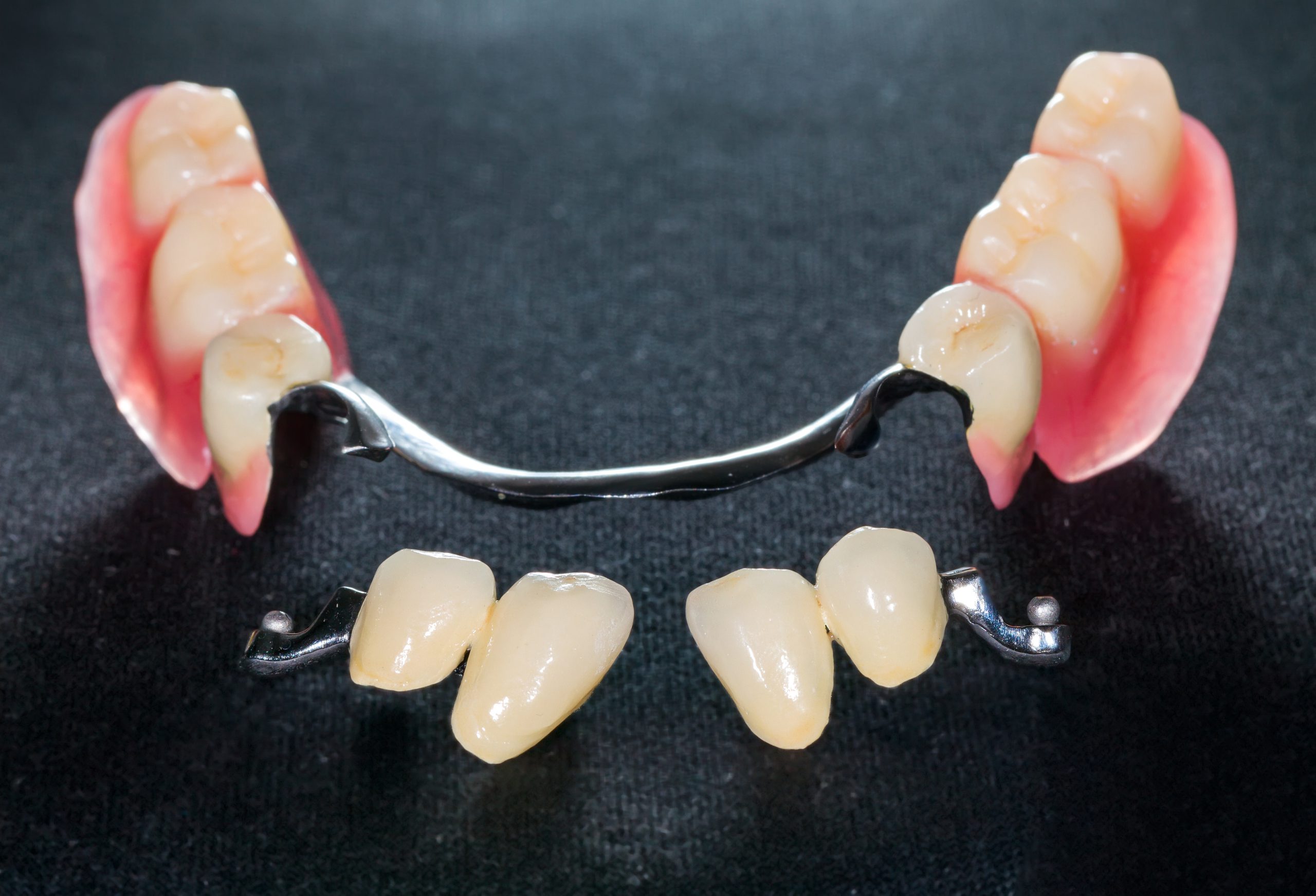 Closeup of dental skeletal prosthesis with porcelain crowns